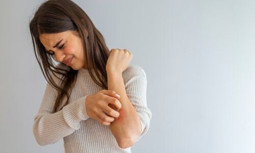 Atopik Dermatit (Egzama) Nedir?