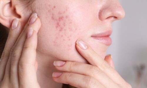 Akneli Ciltler için Dermokozmetik Ürün Tavsiyeleri